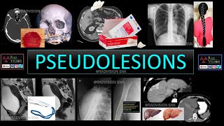 PSEUDOLESIONS [upl. by Ecirtaed]