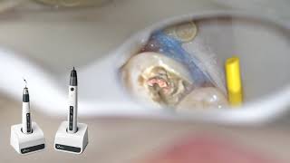 Eighteeth Obturation System  Clinical Case By DrToygan Bora [upl. by Dettmer]