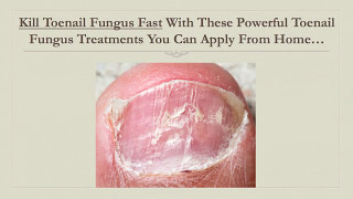 Kill Toenail Fungus Fast With This Powerful Toenail Fungus Treatment You Can Apply From Home [upl. by Roach]