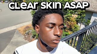 how to get clear skin for guys asap [upl. by Aradnahc157]