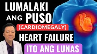 Lumalaki ang Puso Cardiomegaly Heart Failure Ito ang Lunas By Doc Willie Ong [upl. by Onstad619]