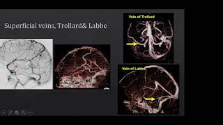 Venous anatomy of Brain CTV MRV and DSA [upl. by Sivehc]