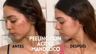 EXPERIENCIA CON PEELING DE ÁCIDO MANDÉLICO  Acné hiperpigmentación piel sensible [upl. by Eardnaed471]