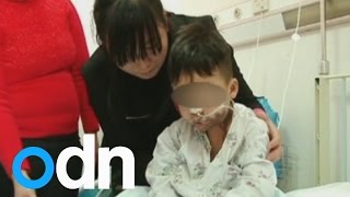 Toddler suffers horrific burns after drinking sulfuric acid [upl. by Cirdec]