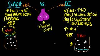 SIADH vs DI [upl. by Dnaltiak]