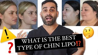 What type of CHIN LIPO is BEST for you [upl. by Ijar803]