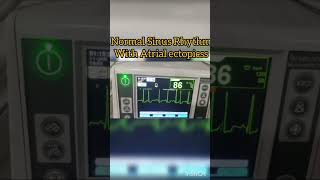 Normal Sinus Rhythm with Atrial Ectopic beats ecg cardiology [upl. by Yspyg]