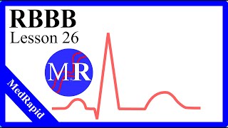 Right Bundle Branch Block RBBB [upl. by Fanni361]