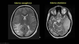 Edema cerebral [upl. by Nelad]