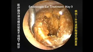 Cholesteatoma Regular review and cleaning [upl. by Anaicilef]