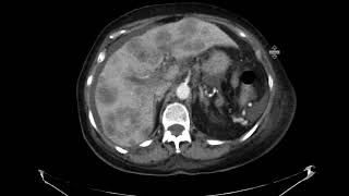 Metastatic pancreatic cancer with PVT PE and DVT [upl. by Ahter]