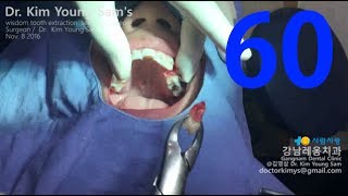 premolar extraction with forceps for orthodontic treatment [upl. by Naujit201]