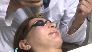 Tratamiento de la Rosacea con Laser DR LUIS EDUARDO MARTINEZ CLINILASER [upl. by Blas]