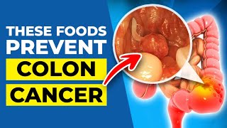 7 INCREDIBLE Foods to Prevent Colon CANCER [upl. by Airamalegna]