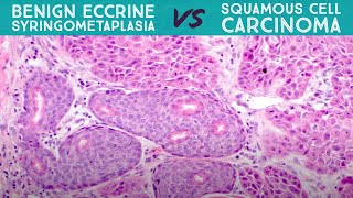 Eccrine Syringometaplasia  benign reactive mimic of squamous cell carcinoma dermpath pathology [upl. by Novelc375]