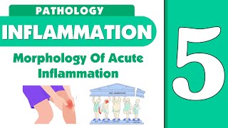 Inflammation lecture 5  morphology of acute inflammation [upl. by Nanda]