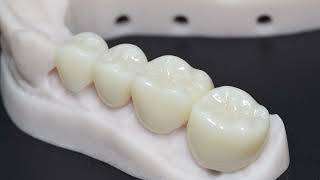 Types of Dental Crowns and Materials  Gold Porcelain Lithium Disilicate amp Zirconia [upl. by Arri473]