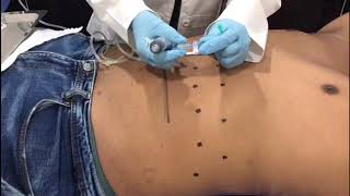 HIDROLIPOCLASIA en abdomen [upl. by Hanoy855]