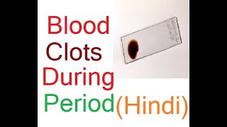 पीरियड में blood clots खून के थक्के आना – माहवारी मासिक धर्म में खून के काले थक्के आना [upl. by Elicia382]