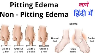 Types Of Edema  Pitting EdemaNon Pitting Edema सूजन के प्रकार और इलाज [upl. by Shornick]