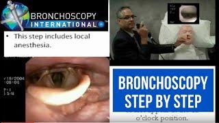 Bronchoscopy Step by Step Walkthrough 16 [upl. by Yltneb]