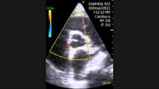 VSCAN Cardiomyopathy of Hypothyroidism Pocket ultrasound Cardiopatía en hipotiroidismo [upl. by Llebana]