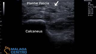 Infiltración Factores de crecimiento  PRP en fascitis plantar [upl. by Dolph]