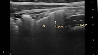 pediatric mesenteric lymphadenitis sono장간막임파선염초음파 [upl. by Eladnar]