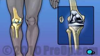 Knee Replacement Surgery PreOp® Patient Education [upl. by Ackley]