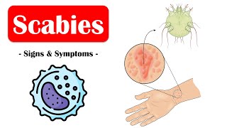 Scabies  Signs amp Symptoms What Are The Commonest Signs amp Symptoms Of Scabies [upl. by Ley]