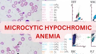 MICROCYTIC HYPOCHROMIC ANEAMIA  CASE BASED DISCUSSION  IDA  THALESSEMIA  AOCD SIDERBLASTIC [upl. by Sybil]