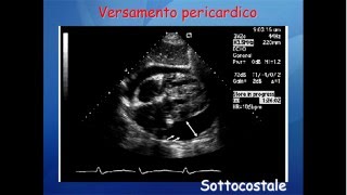 Elementi di ecocardiografia VI video versamento pericardico [upl. by Phylis238]