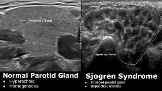 Salivary Glands Ultrasound Normal Vs Abnormal Images  Parotid Submandibular amp Sublingual Gland USG [upl. by Allison733]