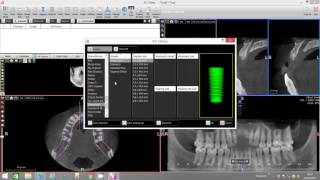 Implant Placement with Bone Density Assessment  XMind Trium [upl. by Llenral296]