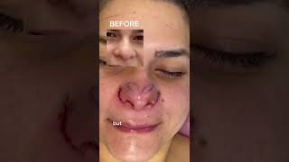 ALARPLASTY AND TIPPLASTY BEFORE AND AFTER  DR TANVEER JANJUA  NEW JERSEY [upl. by Eusadnilem]