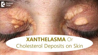 FATTY DEPOSITS of CHOLESTEROL around EYES  How to get rid of itDrRajdeep MysoreDoctors Circle [upl. by Nottus682]