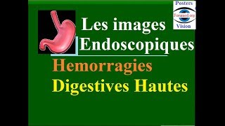 Les images endoscopiques et causes des hémorragies digestive hautes fibroscopie gastrique endoscopie [upl. by Bettina]