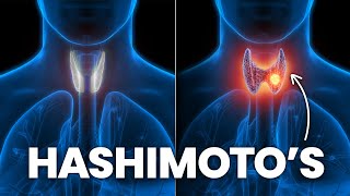 How To Stop Hashimoto’s From Turning Into Hypothyroidism [upl. by Betsey757]