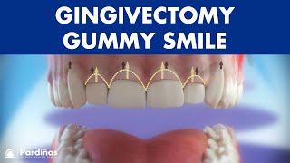 Gingivectomy  Treatment for gummy smile © [upl. by Illona2]