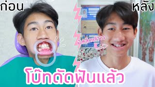 โบ๊ทดัดฟัน ครั้งแรกในชีวิต EP1 ใส่เหล็กแล้วว [upl. by Boardman]