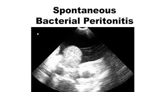 Spontaneous Bacterial Peritonitis  Definition causes symptoms Diagnosis treatment [upl. by Akcire917]