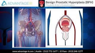 Prostate artery embolization for benign prostatic hyperplasia [upl. by Iroak]