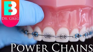 BRACES EXPLAINED Power Chains [upl. by Ahsemac]