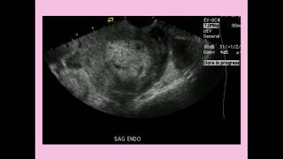 Endometritis  CRASH Medical Review Series [upl. by Nodrog458]