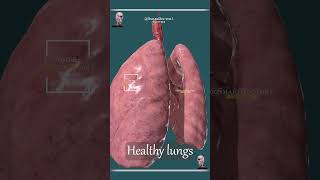 Smokers Lungs 🚭 VS Non Smokers Lungs 🫁 [upl. by Clemen904]