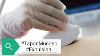 👁‍🗨 TAPON MUCOSO ✅ Cuanto Falta para El Parto [upl. by Mitzl90]