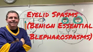 Eyelid Spasms Benign Essential Blepharospasm [upl. by Ynnor]