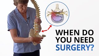 Disc Herniation When Do You Need Surgery PLUS Fixing the Root Cause [upl. by Lisette]