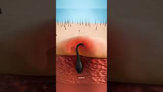 How Ingrown Hair Is Formed [upl. by Eahsel]