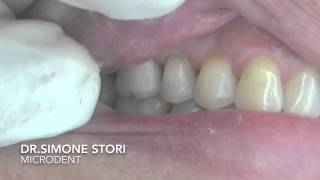 Dente affetto da Parodontite Severa Curato con Laser [upl. by Assecnirp230]